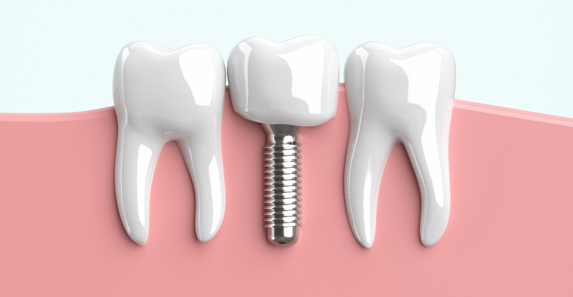 IMPLANT インプラント