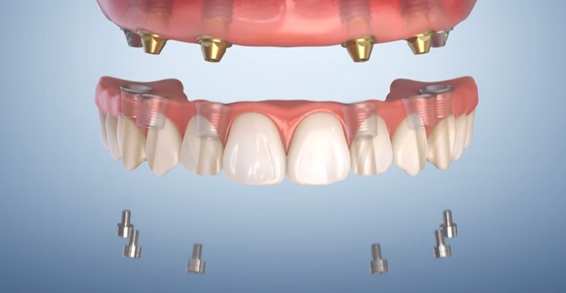 ALLON4 オールオン4
